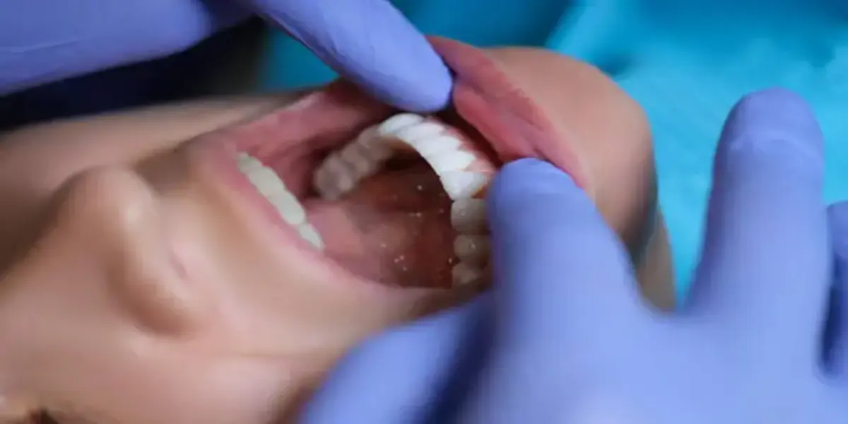 Composite-Veneers