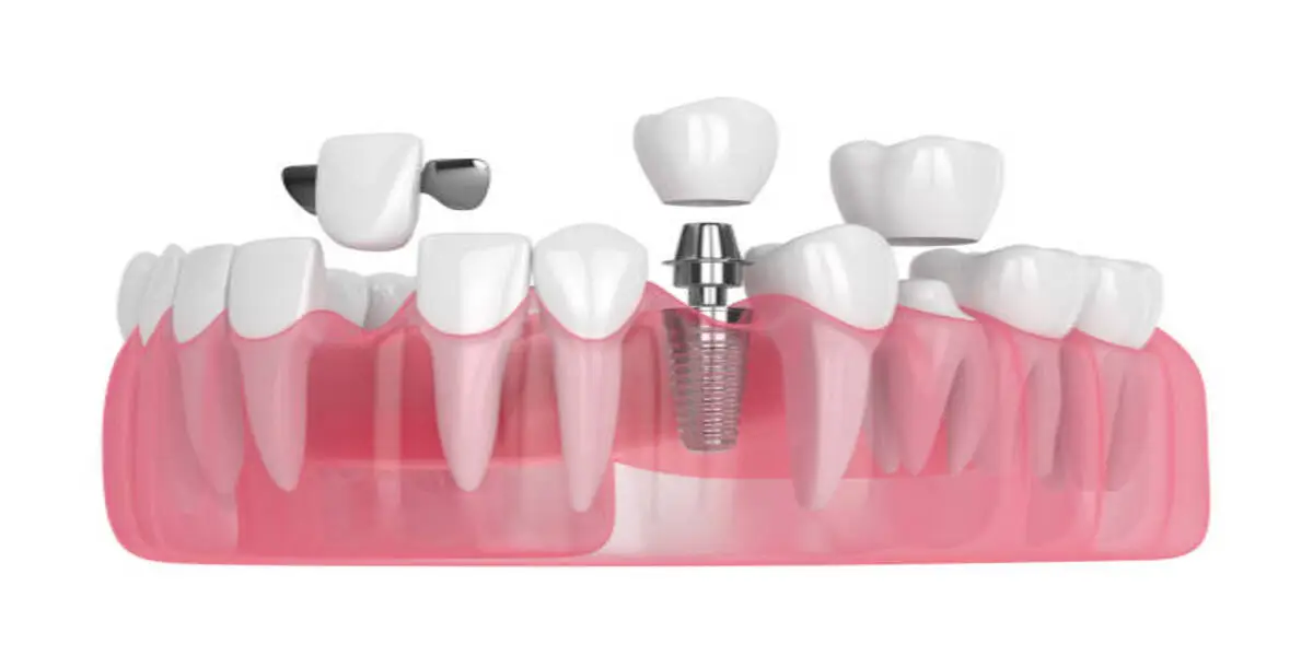 Dental Crown Bridges