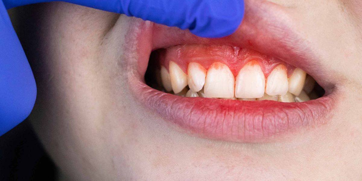 Gum Recession Treatment in Islamabad