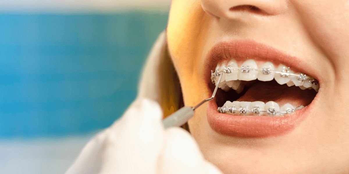 Dental Braces In Islamabad