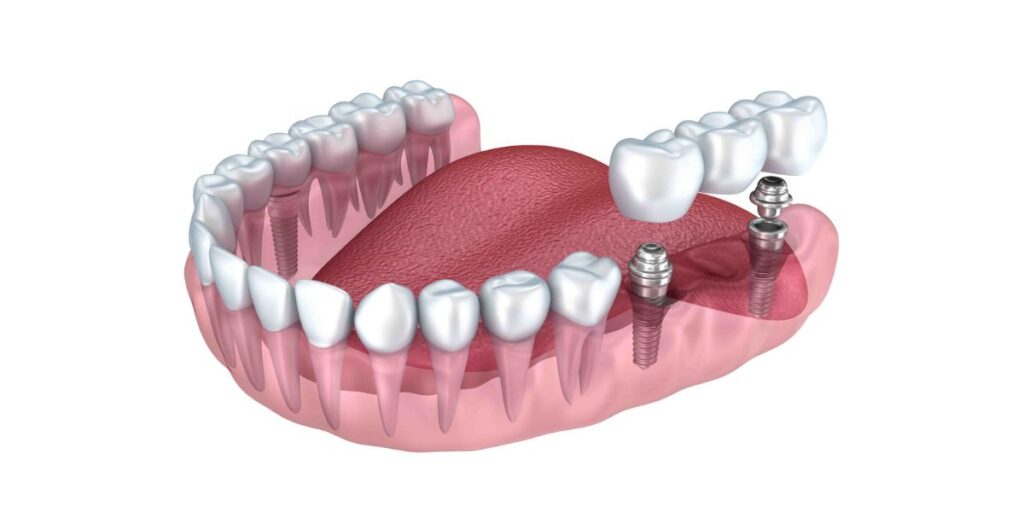 Dental Implants in Islamabad, Rawalpindi & Pakistan