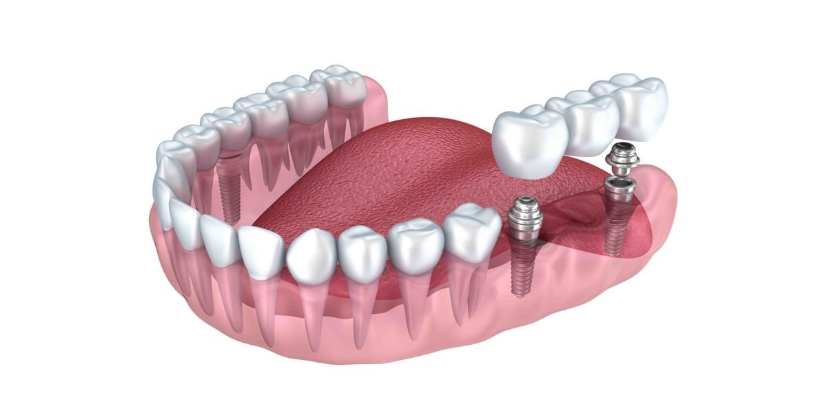 Dental Implants in Islamabad