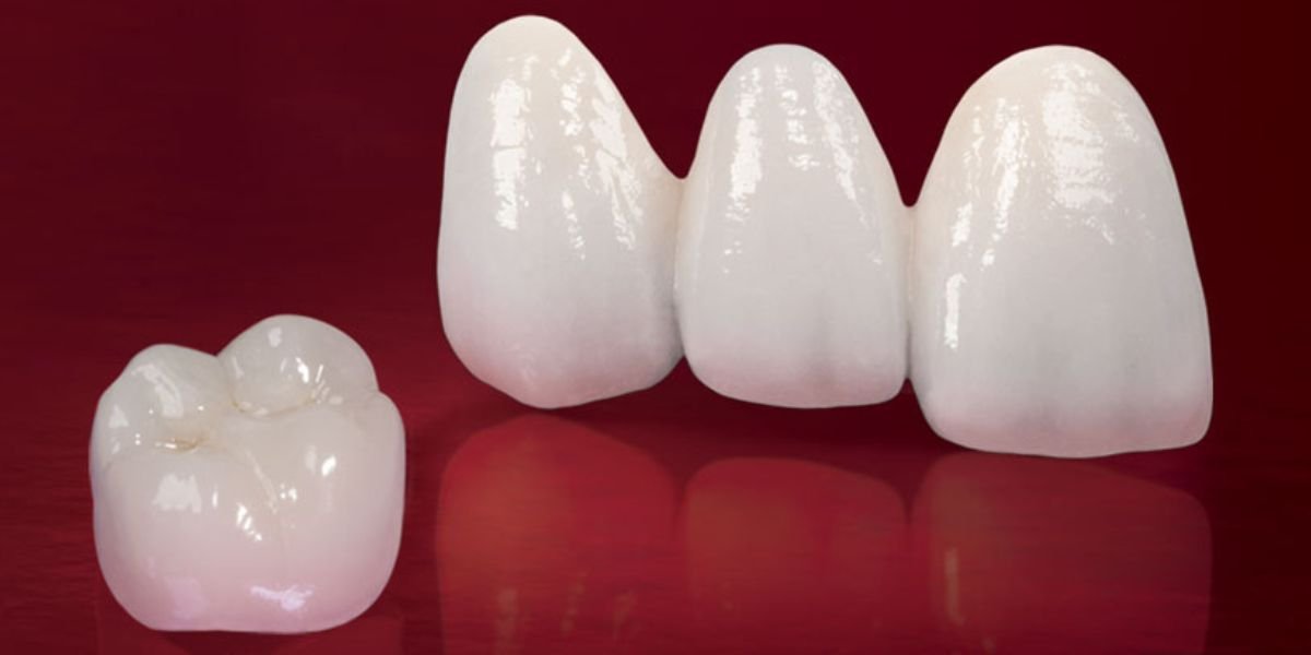 Difference Between Zirconia And Porcelain Crowns