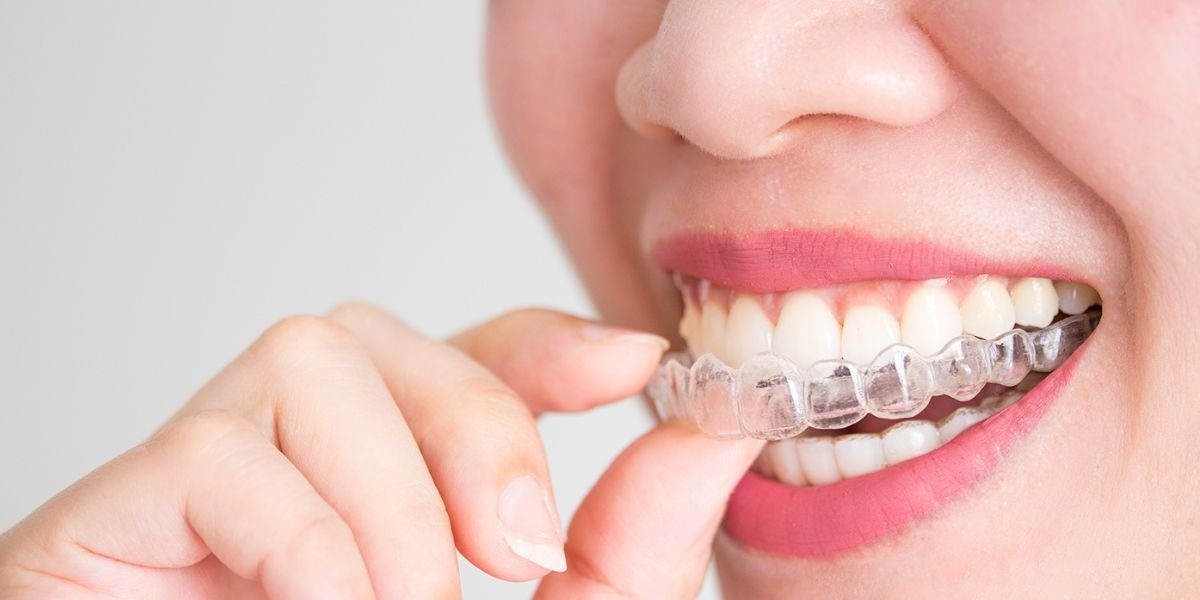 Invisalign Treatment in Islamabad