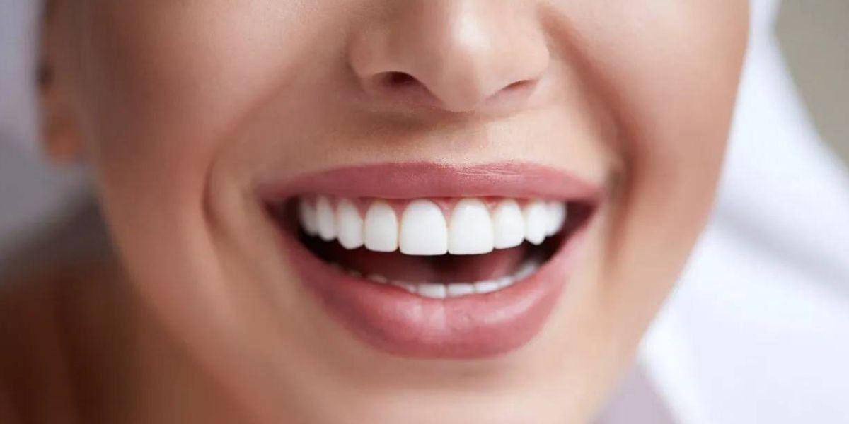 Non Prep Veneers in Islamabad