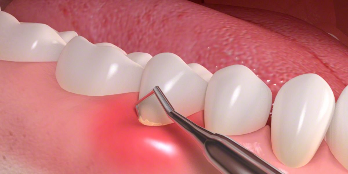 Periodontics and Gum Disease Treatment in Islamabad