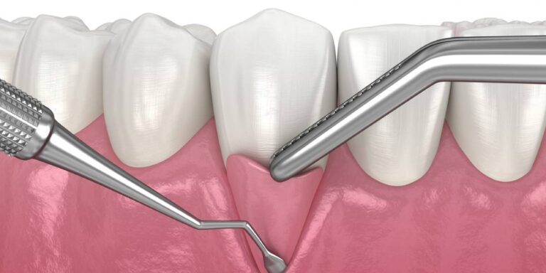 Is There Any Alternative To Gum Grafting?